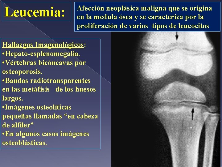 Leucemia: Afección neoplásica maligna que se origina en la medula ósea y se caracteriza