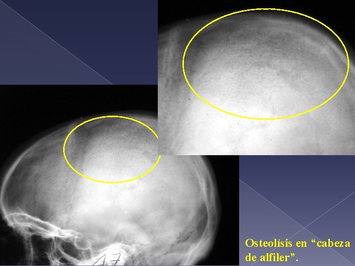 Osteolísis en “cabeza de alfiler”. 