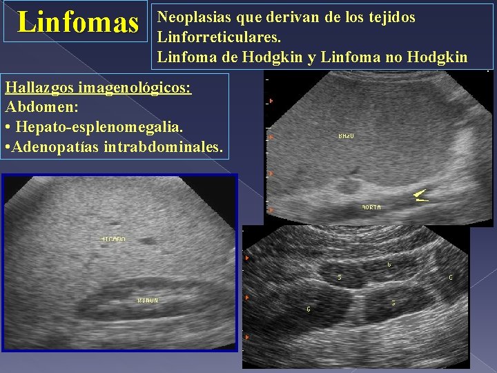 Linfomas Neoplasias que derivan de los tejidos Linforreticulares. Linfoma de Hodgkin y Linfoma no