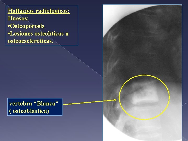 Hallazgos radiológicos: Huesos: • Osteoporosis • Lesiones osteolíticas u osteoescleróticas. vértebra “Blanca” ( osteoblástica)