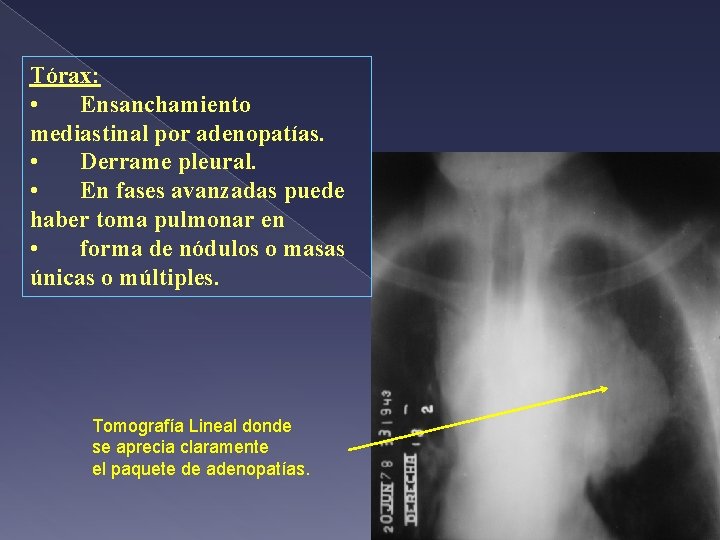 Tórax: • Ensanchamiento mediastinal por adenopatías. • Derrame pleural. • En fases avanzadas puede