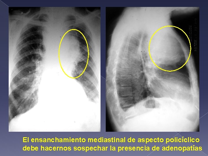 El ensanchamiento mediastinal de aspecto policíclico debe hacernos sospechar la presencia de adenopatías 