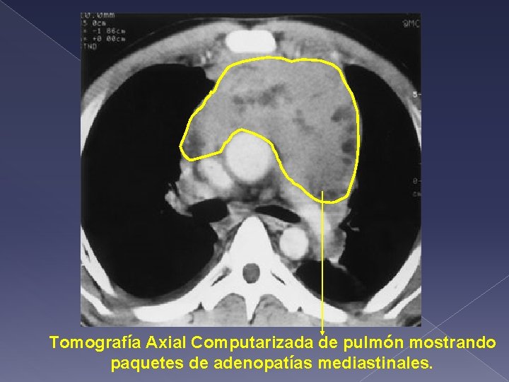 Tomografía Axial Computarizada de pulmón mostrando paquetes de adenopatías mediastinales. 