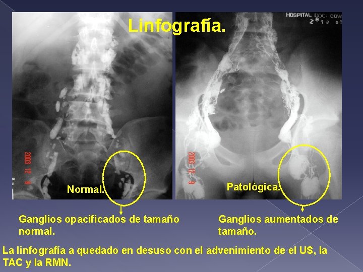 Linfografía. Normal. Ganglios opacificados de tamaño normal. Patológica. Ganglios aumentados de tamaño. La linfografía