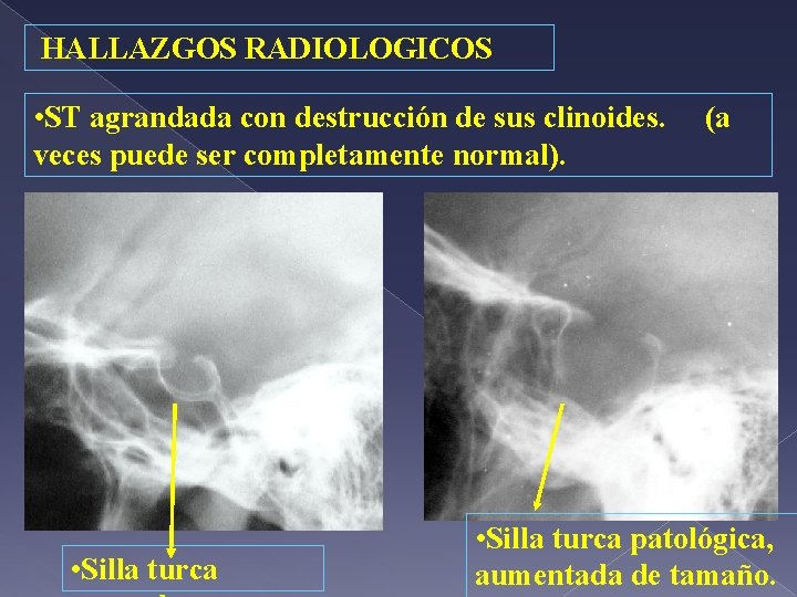HALLAZGOS RADIOLOGICOS • ST agrandada con destrucción de sus clinoides. veces puede ser completamente