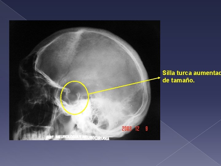 Silla turca aumentad de tamaño. 