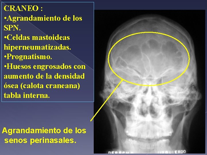 CRANEO : • Agrandamiento de los SPN. • Celdas mastoideas hiperneumatizadas. • Prognatismo. •