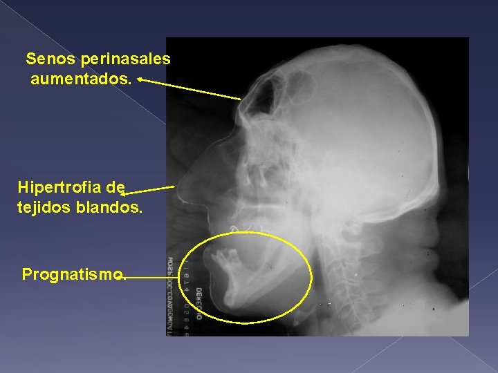 Senos perinasales aumentados. Hipertrofia de tejidos blandos. Prognatismo. 