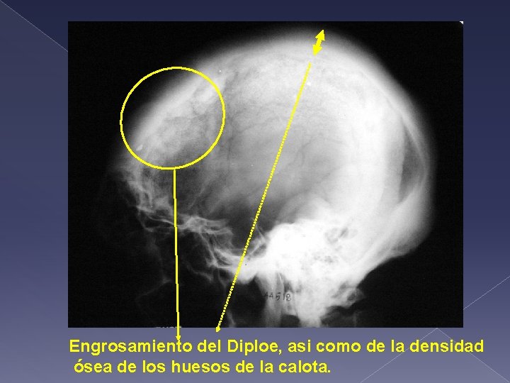 Engrosamiento del Diploe, asi como de la densidad ósea de los huesos de la
