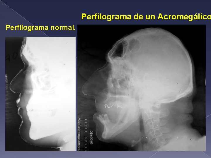 Perfilograma de un Acromegálico Perfilograma normal. 