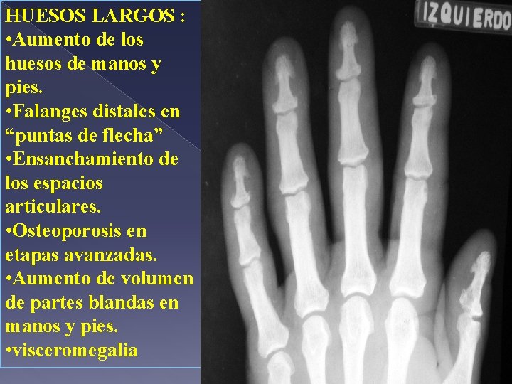 HUESOS LARGOS : • Aumento de los huesos de manos y pies. • Falanges