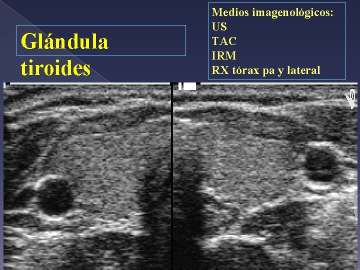 Glándula tiroides Medios imagenológicos: US TAC IRM RX tórax pa y lateral 