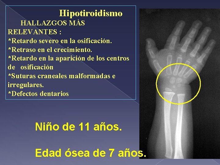 Hipotiroidismo HALLAZGOS MÁS RELEVANTES : *Retardo severo en la osificación. *Retraso en el crecimiento.