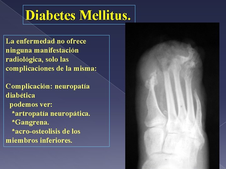 Diabetes Mellitus. La enfermedad no ofrece ninguna manifestación radiológica, solo las complicaciones de la