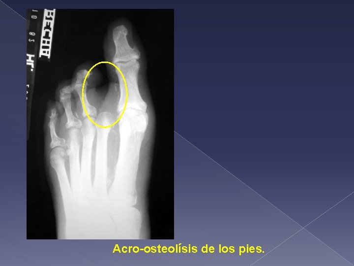 Acro-osteolísis de los pies. 