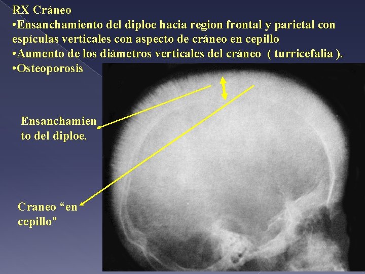 RX Cráneo • Ensanchamiento del diploe hacia region frontal y parietal con espículas verticales