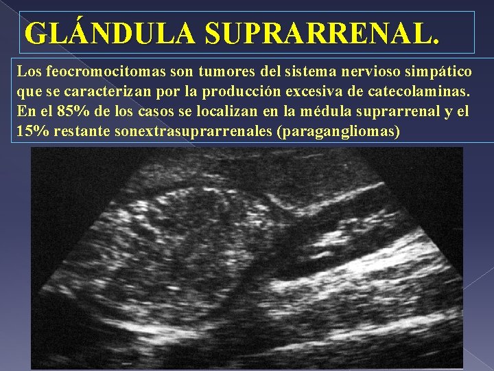 GLÁNDULA SUPRARRENAL. Los feocromocitomas son tumores del sistema nervioso simpático que se caracterizan por