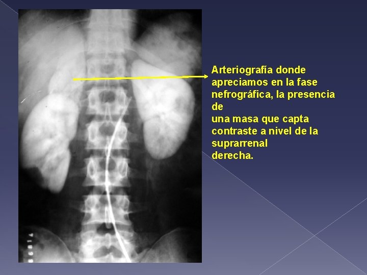 Arteriografía donde apreciamos en la fase nefrográfica, la presencia de una masa que capta
