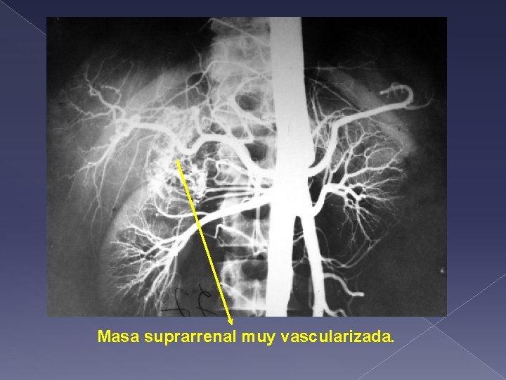 Masa suprarrenal muy vascularizada. 