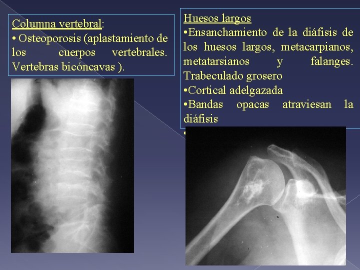 Columna vertebral: • Osteoporosis (aplastamiento de los cuerpos vertebrales. Vertebras bicóncavas ). Huesos largos