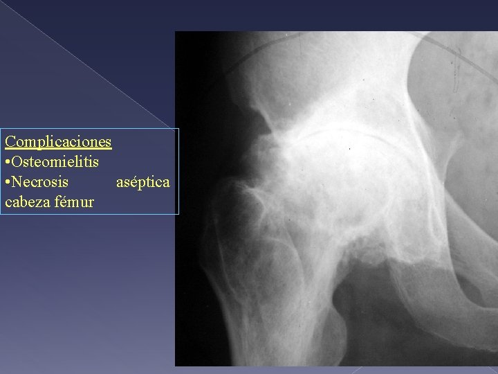 Complicaciones • Osteomielitis • Necrosis aséptica cabeza fémur 