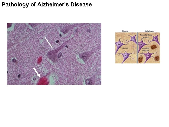 Pathology of Alzheimer’s Disease 