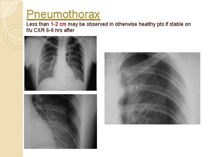 Pneumothorax Less than 1 -2 cm may be observed in otherwise healthy pts if