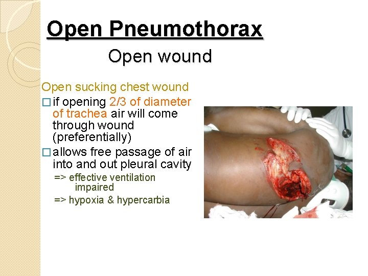 Open Pneumothorax Open wound Open sucking chest wound � if opening 2/3 of diameter