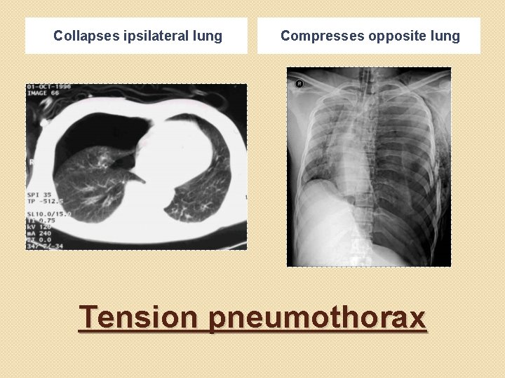 Collapses ipsilateral lung Compresses opposite lung Tension pneumothorax 