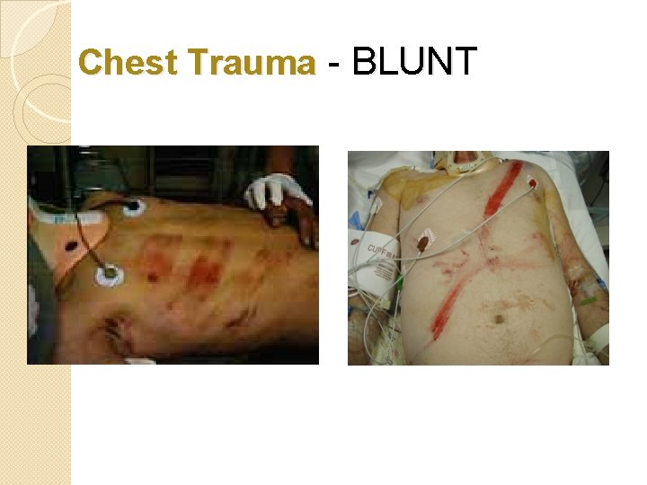 Chest Trauma - BLUNT 