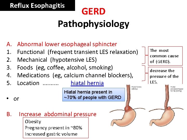 Reflux Esophagitis GERD Pathophysiology A. 1. 2. 3. 4. 5. Abnormal lower esophageal sphincter