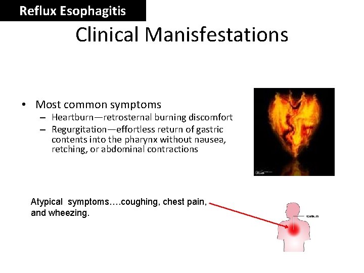 Reflux Esophagitis Clinical Manisfestations • Most common symptoms – Heartburn—retrosternal burning discomfort – Regurgitation—effortless