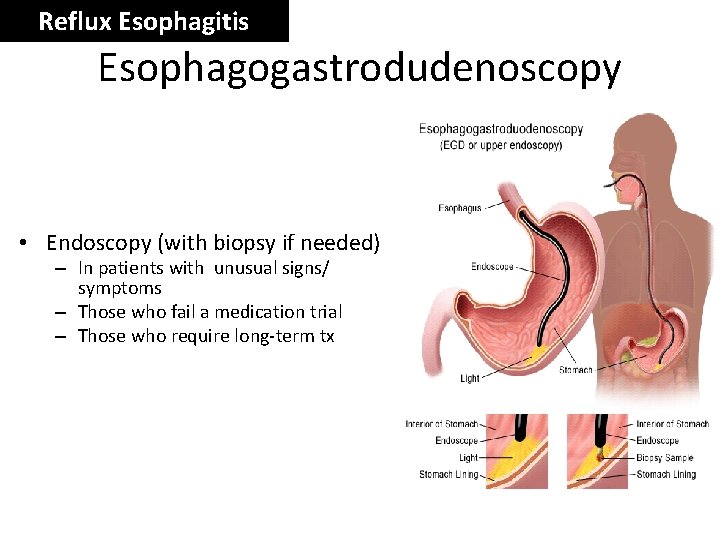 Reflux Esophagitis Esophagogastrodudenoscopy • Endoscopy (with biopsy if needed) – In patients with unusual