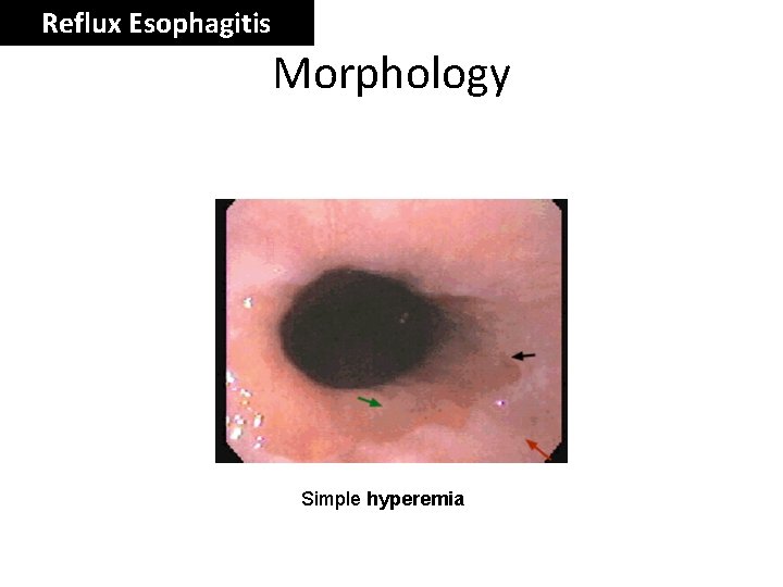 Reflux Esophagitis Morphology Simple hyperemia 
