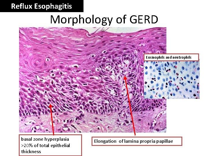 Reflux Esophagitis Morphology of GERD Eosinophils and neutrophils basal zone hyperplasia >20% of total