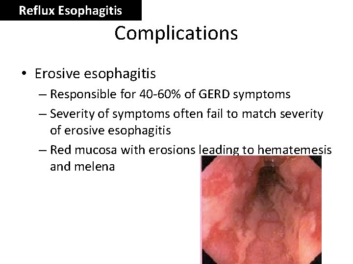 Reflux Esophagitis Complications • Erosive esophagitis – Responsible for 40 -60% of GERD symptoms