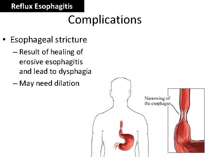 Reflux Esophagitis Complications • Esophageal stricture – Result of healing of erosive esophagitis and