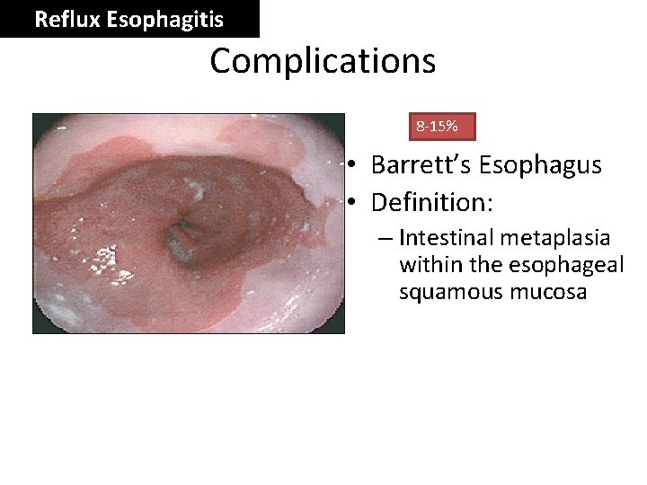 Reflux Esophagitis Complications 8 -15% • Barrett’s Esophagus • Definition: – Intestinal metaplasia within