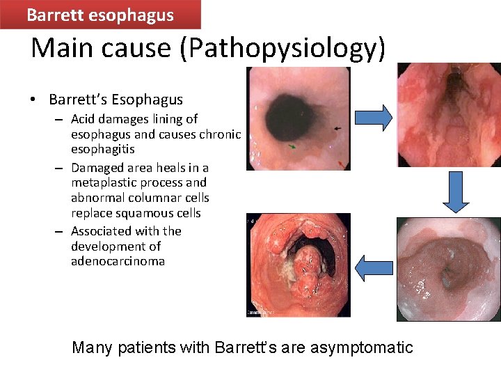 Barrett esophagus Main cause (Pathopysiology) • Barrett’s Esophagus – Acid damages lining of esophagus