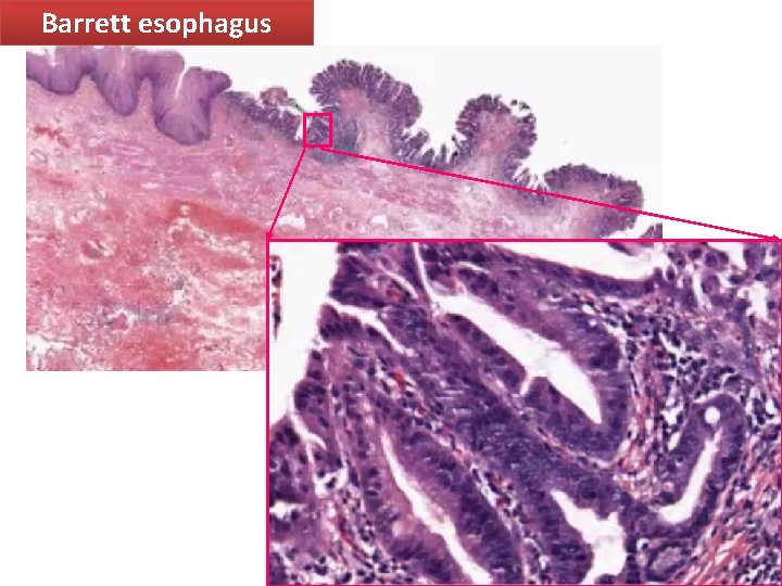 Barrett esophagus 