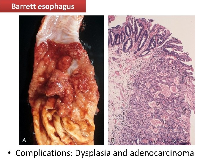 Barrett esophagus • Complications: Dysplasia and adenocarcinoma 