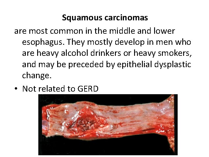 Squamous carcinomas are most common in the middle and lower esophagus. They mostly develop