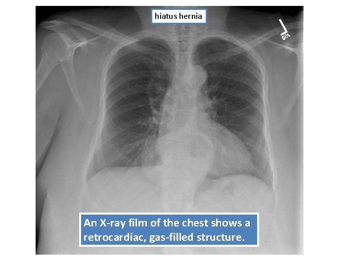 hiatus hernia An X-ray film of the chest shows a retrocardiac, gas-filled structure. 