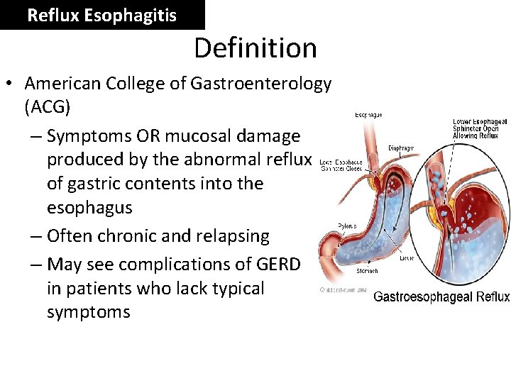 Reflux Esophagitis Definition • American College of Gastroenterology (ACG) – Symptoms OR mucosal damage