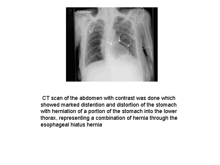 CT scan of the abdomen with contrast was done which showed marked distention and