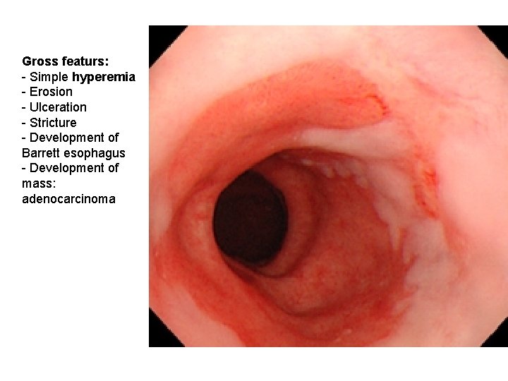 Gross featurs: - Simple hyperemia - Erosion - Ulceration - Stricture - Development of