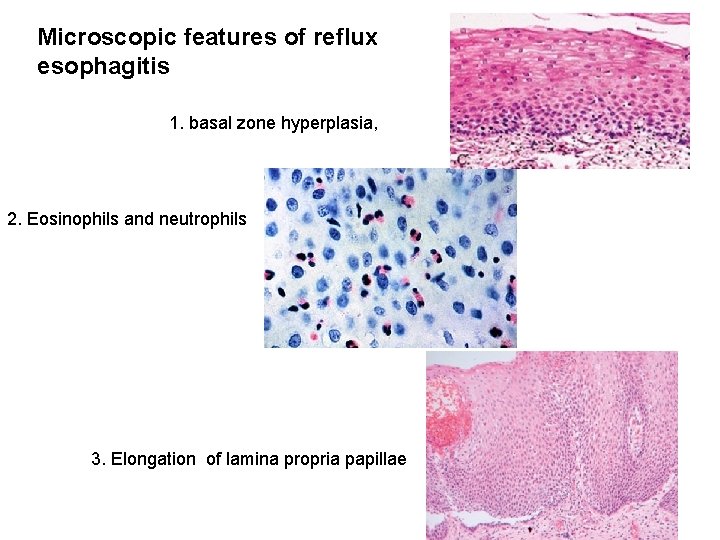 Microscopic features of reflux esophagitis 1. basal zone hyperplasia, 2. Eosinophils and neutrophils 3.