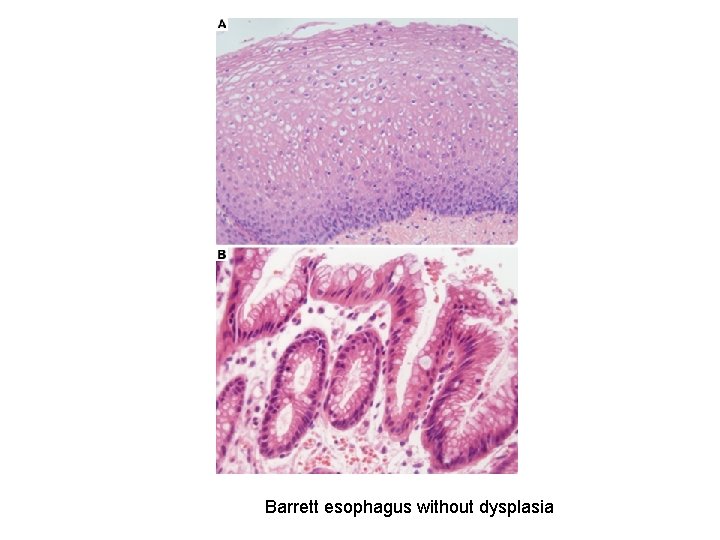 Barrett esophagus without dysplasia 