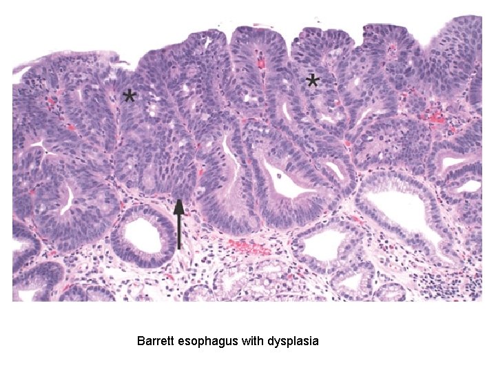 Barrett esophagus with dysplasia 