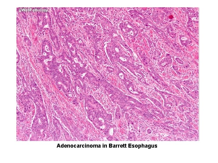 Adenocarcinoma in Barrett Esophagus 